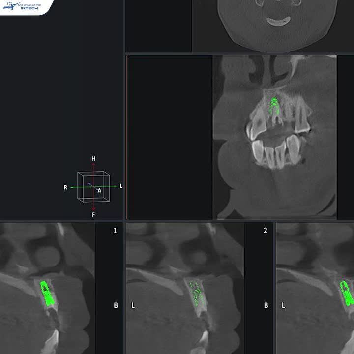 KHẮC PHỤC TRIỆT ĐỂ TÌNH TRẠNG THẨM MỸ RĂNG IMPLANT BỊ ÁNH ĐEN NHỜ CÔNG NGHỆ TRỒNG RĂNG HIỆN ĐẠI