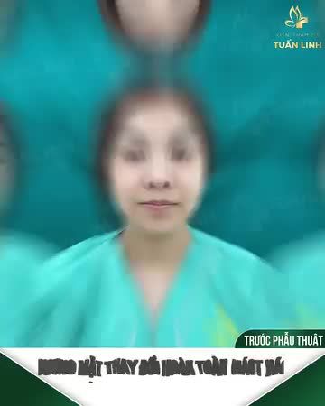 Xinh sang, trẻ đẹp hơn với combo nâng mũi + độn cằm!!!