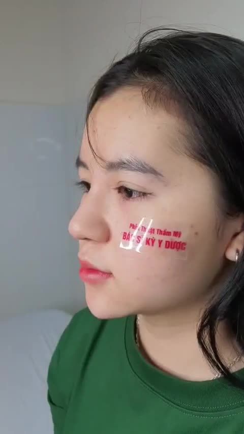 Nâng mũi Aline sau 12 ngày