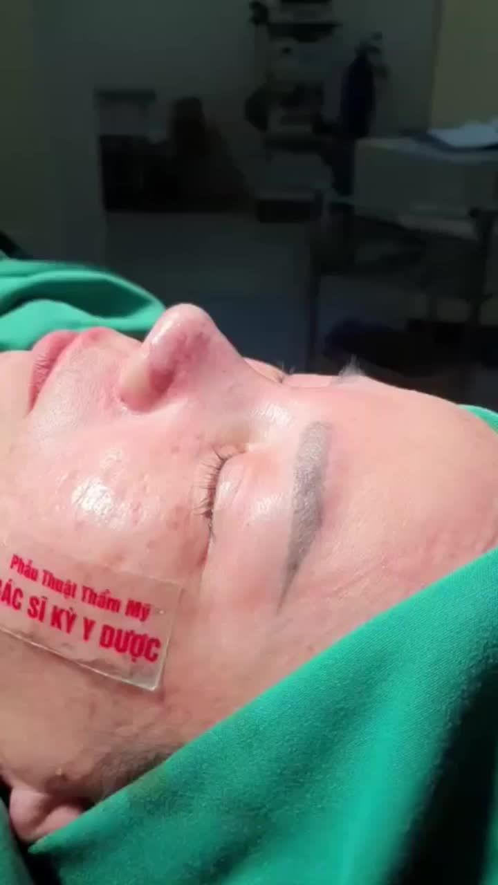 Nâng mũi ALINE