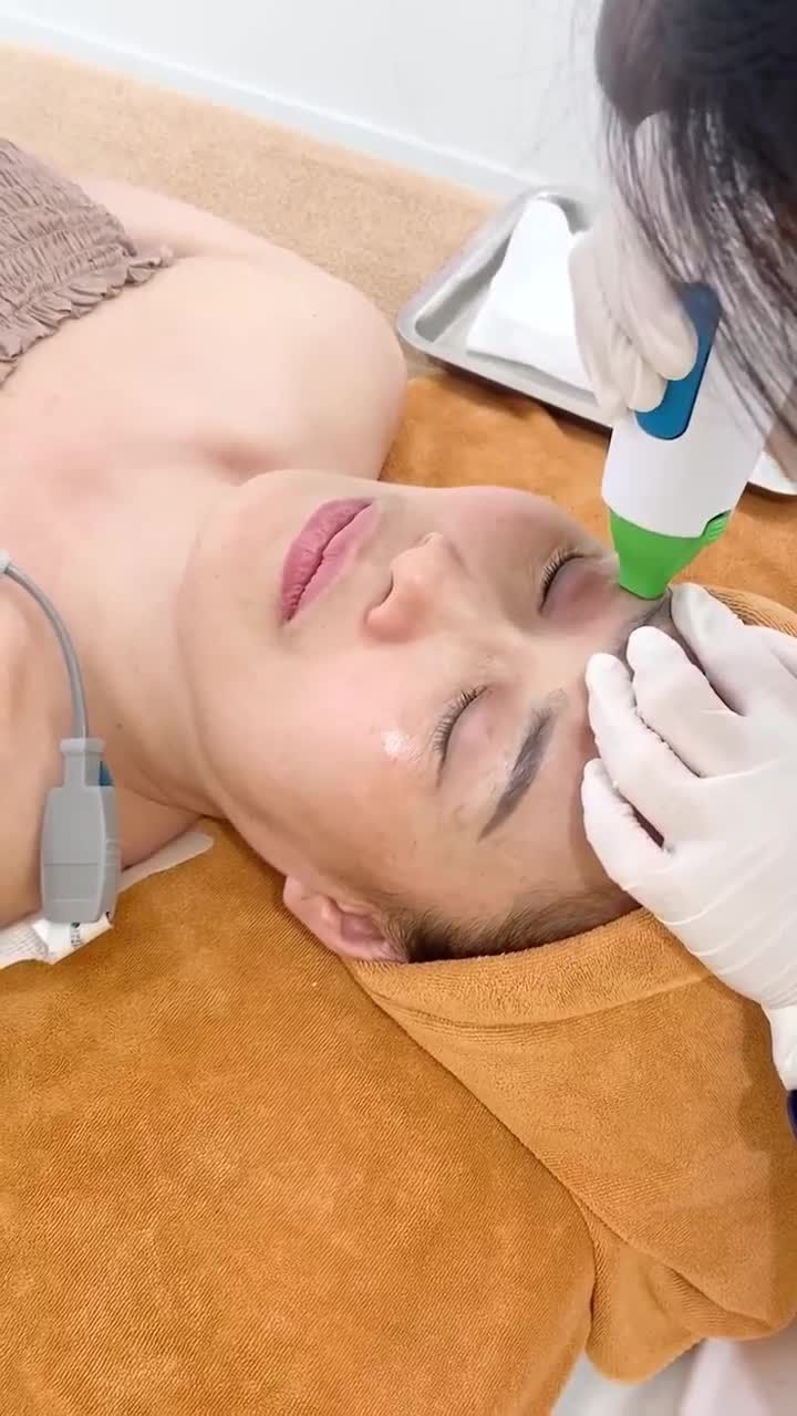 Trẻ hóa vùng mắt bằng công nghệ Thermage 4.0 FLX.