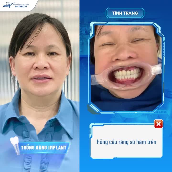 GIẢI PHÁP KHẮC PHỤC HIỆU QUẢ NÀO CHO BỆNH NHÂN GẶP BIẾN CHỨNG CẦU RĂNG SỨ?