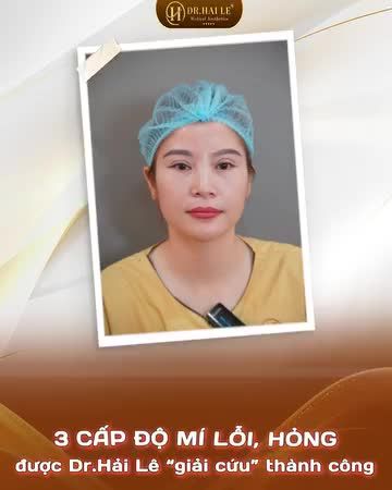 3 cấp độ mí lỗi, hỏng được Dr Hải Lê giải cứu thành công