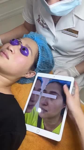 Trị nám buổi 3 cho chị khách hàng