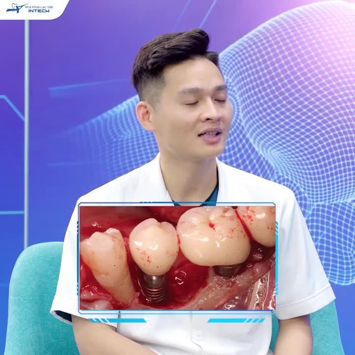 ĐÀO THẢI TRỤ IMPLANT - NGUYÊN NHÂN VÀ GIẢI PHÁP NÀO ĐỂ KHẮC PHỤC?