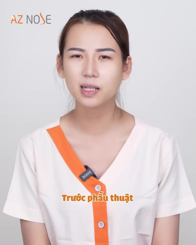 Từng stress nặng vì chiếc mũi lệch, cô gái đến từ BếnTre vượt qua như thế nào?