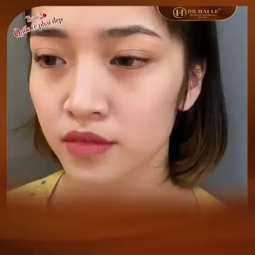 Nâng mũi Dr Hải Lê diễn ra như thế nào?