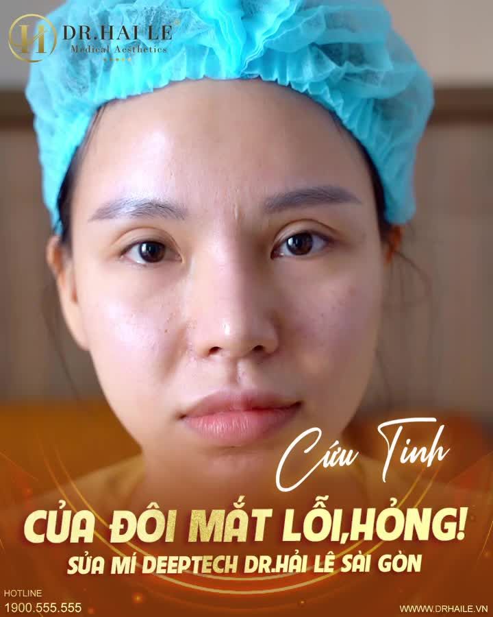 Sửa mí hỏng cứu tinh cho đôi mắt