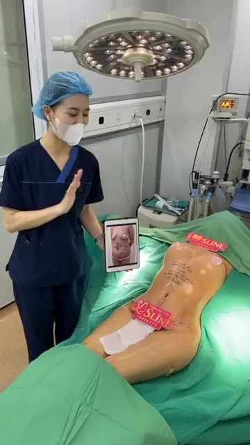 KẾT QUẢ COMBO NÂNG V1 VÀ HÚT MỠ SIẾT EO 360