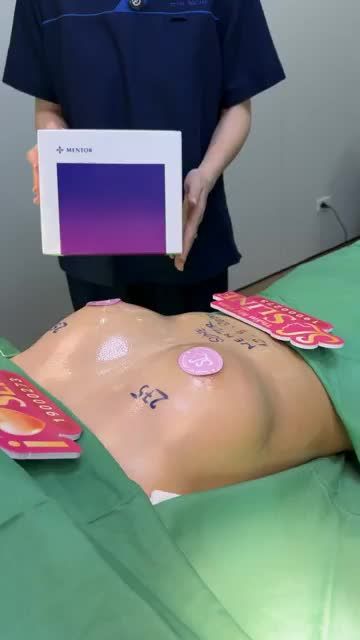 Một form ngự.c đẹp tự nhiên cho khách hàng đầy tiên trong ngày hôm nay! …Và đây là kết quả ca phẫu thuật nâng cấp v1 với dòng túi Mentor
