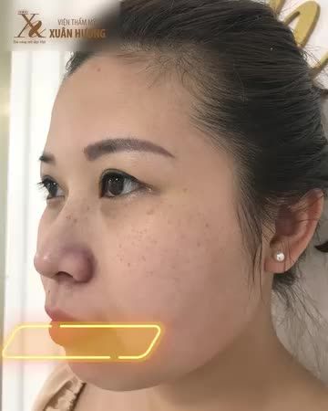 1 lần thực hiện mờ đến 90% tàn nhang, mực xăm mí được loại bỏ sạch