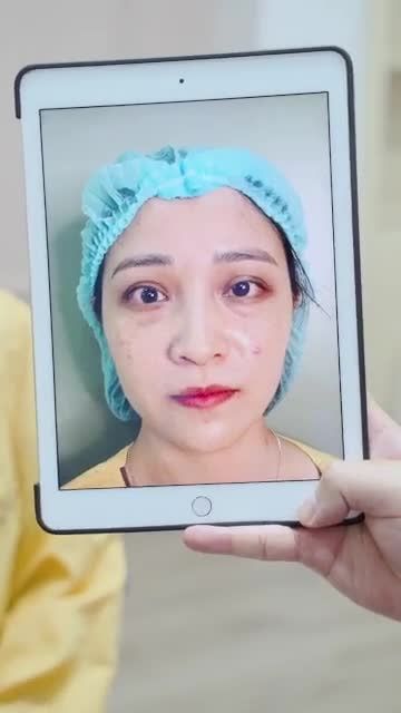 Mí bệnh lý bẩm sinh từng can thiệp tại cơ sở thẩm mỹ khác mà không thành công, kết quả vị khách hàng nhận lại là đôi mắt lỗi nặng hơn mắt nguyên bản.