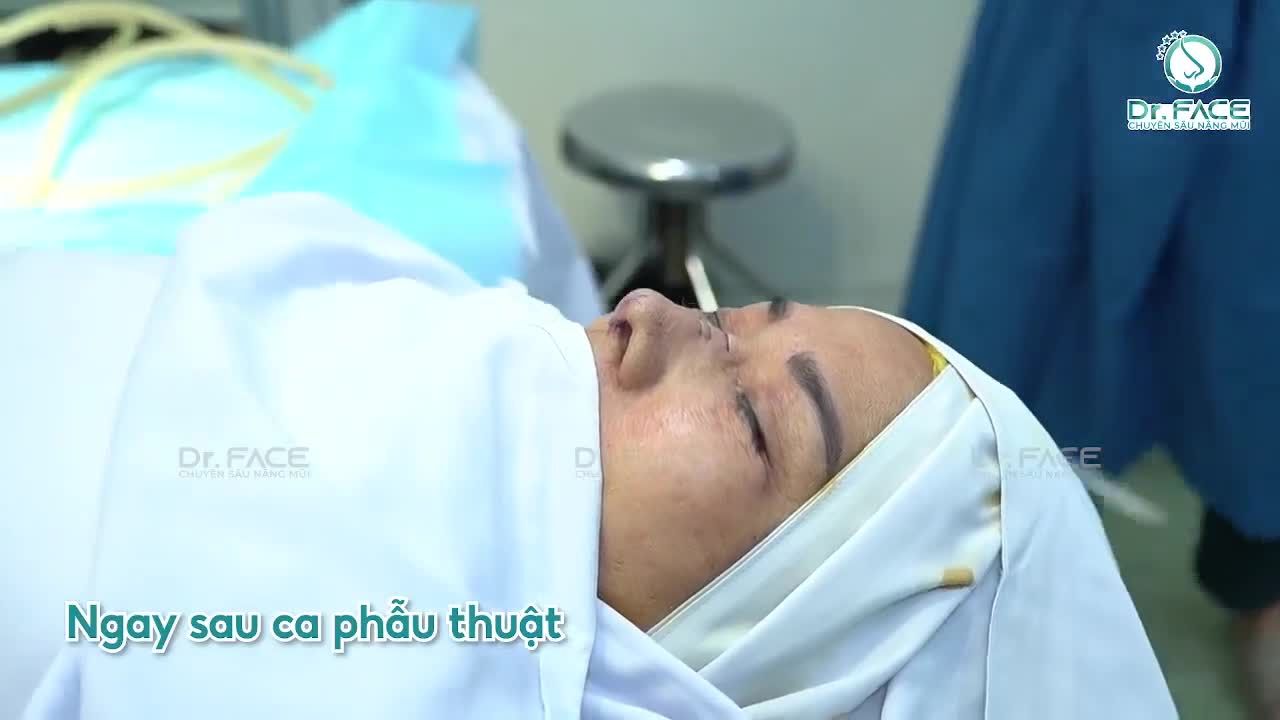 Nâng Mũi Sụn Sườn Cho Một Bác Sĩ Đồng Nghiệp