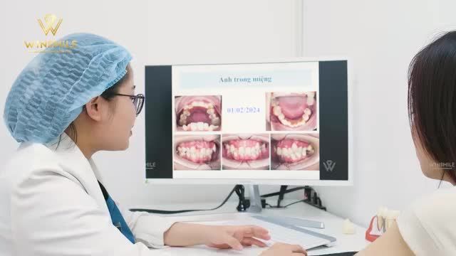 RĂNG KHẤP KHỂNH NHIỀU NIỀNG, MẶT NGHIÊNG LỒI NIỀNG RĂNG CÓ THỂ KHẮC PHỤC?