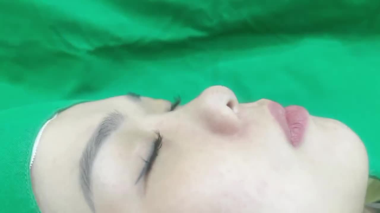 XÓA SỔ mũi thấp tẹt một cách dễ dàng nhờ phương pháp nâng mũi độc quyền 4S- 2Lớp.