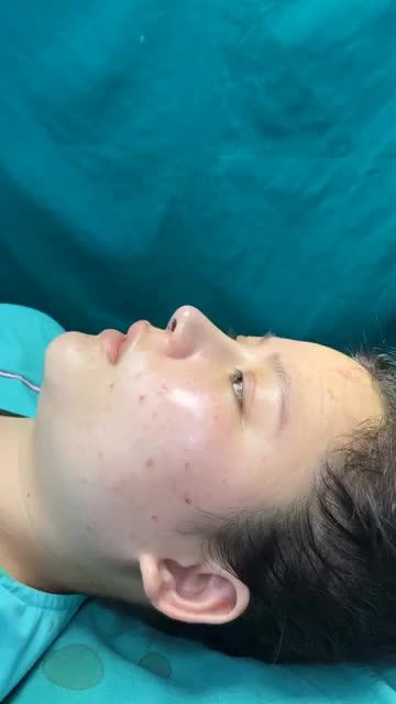 Case mũi cấu trúc vừa hoàn thành cho bạn gái đến từ Bến Tre!!