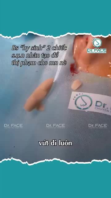 SỤN SƯỜN CÒN CÓ NHIỀU LOẠI nữa hả bs?