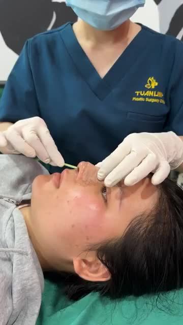 Case cấu trúc sau 5 ngày