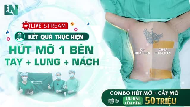 Hiện tại ekip Bác sĩ Lương Ngọc đã thực hiện xong ½ quá trình hút mỡ kết hợp vùng tay - lưng - nách cho chị Thu Thủy.