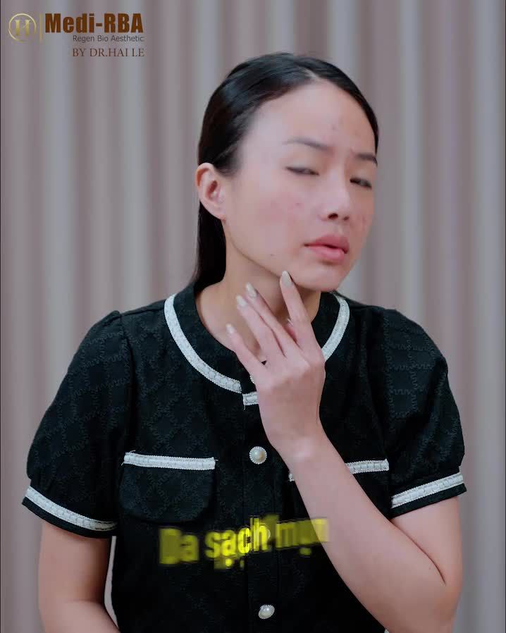 Người người nhà nhà nói rằng làm xong Meso da sạch mụn, căng bóng, trắng hồng mà không biết có hiệu quả thật không?
