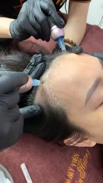 Vì chạm sắc tố da đầu