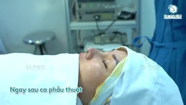 CHỌN SỤN QUÁ NHỎ THÌ SẼ RA SAO?