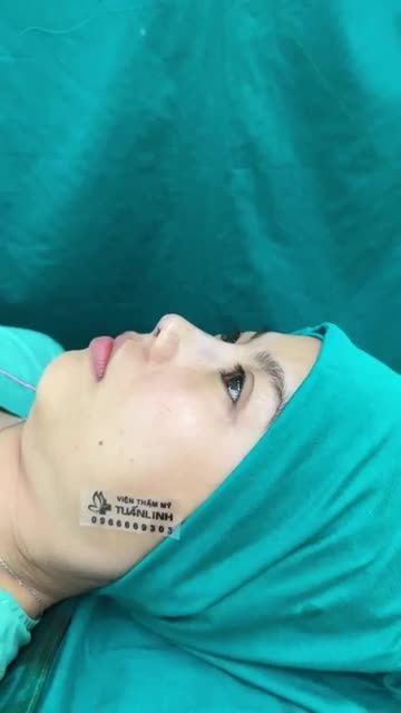 Ca mũi cấu trúc vừa hoàn xong