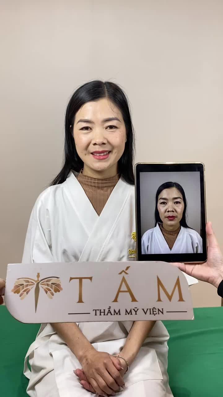 TRẺ TRUNG HƠN SAU KHI LÀM FILLER MÁ TẠI TMV TẤM