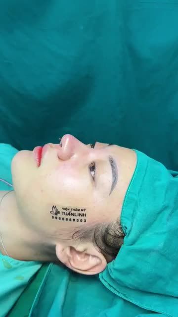 Ca nâng mũi cấu trúc vừa hoàn thành