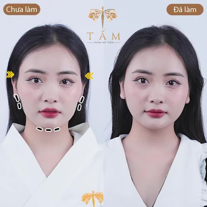 LÀM ĐẸP ĐẦU NĂM - CẢ NĂM XINH ĐẸP VỚI FILLER