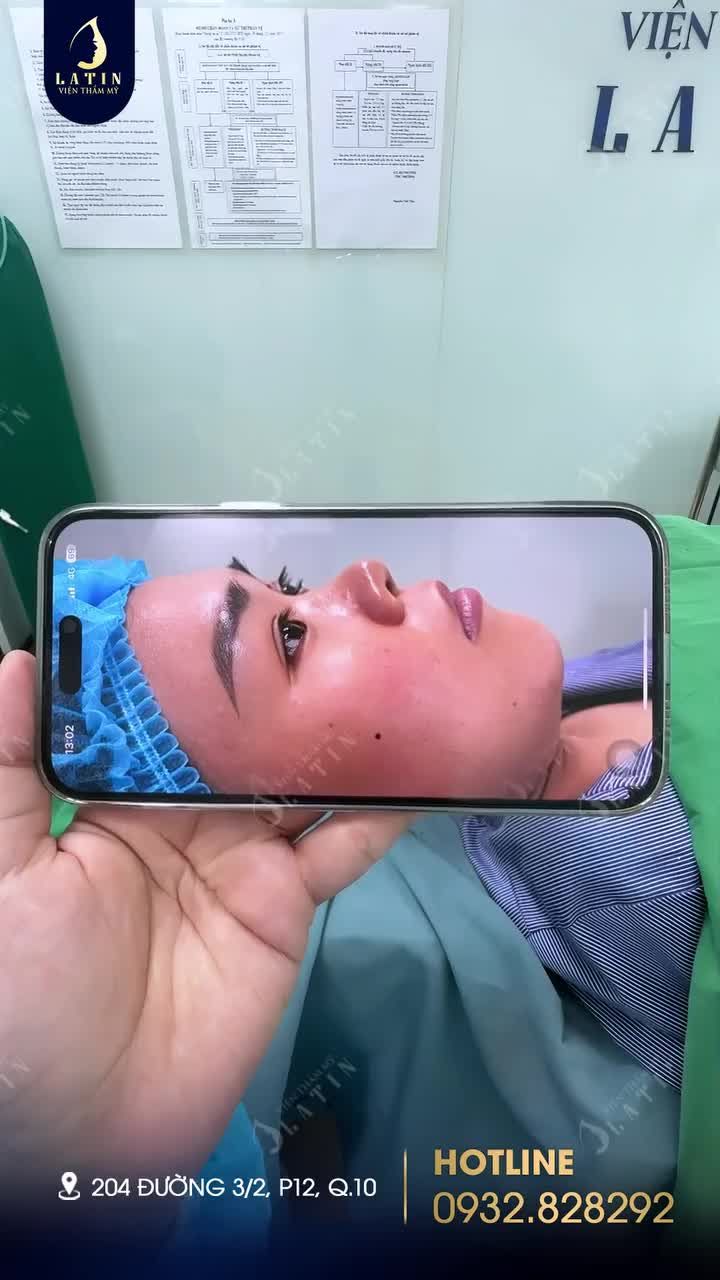 Kết quả nâng mũi cấu trúc sụn tai, sóng surgiform cho em gái H.T