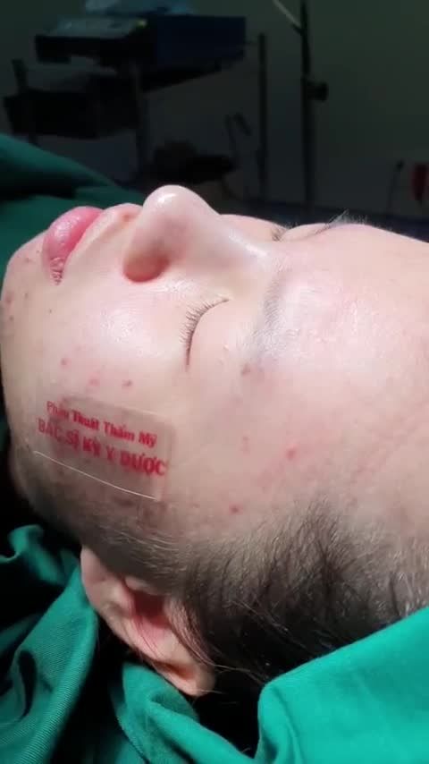 Nâng mũi Aline bán cấu trúc đa lớp
