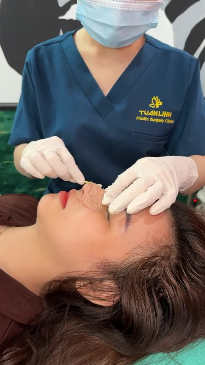 Case mũi bọc sụn sau 10 ngày