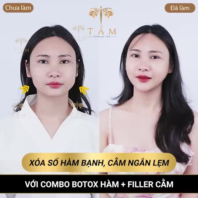 HÀM VLINE THON GỌN - CẰM TRÒN ĐẦY ĐẸP TỰ NHIÊN