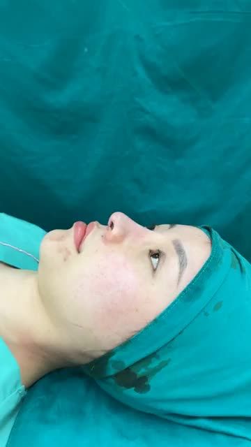 Case mũi Tái cấu trúc dáng tự nhiên vừa hoàn thành
