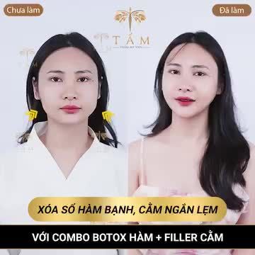 HÀM VLINE THON GỌN - CẰM TRÒN ĐẦY ĐẸP TỰ NHIÊN