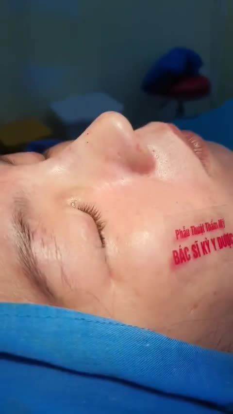 Nâng mũi ALINE dáng mũi vừa phong thuỷ, vừa đẹp về thẩm mỹ cho chị khách.