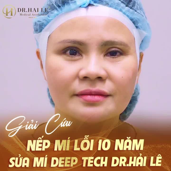 Sống chung với mí hỏng nặng trong suốt 10 năm, chạy chữa tại 2 cơ sở nổi tiếng tại Sài Gòn nhưng "càng làm càng hỏng". Đến với Dr.Hải Lê, chị gái đã trao trọn niềm tin và nhận lại cho mình niềm vui vô bờ bến!
