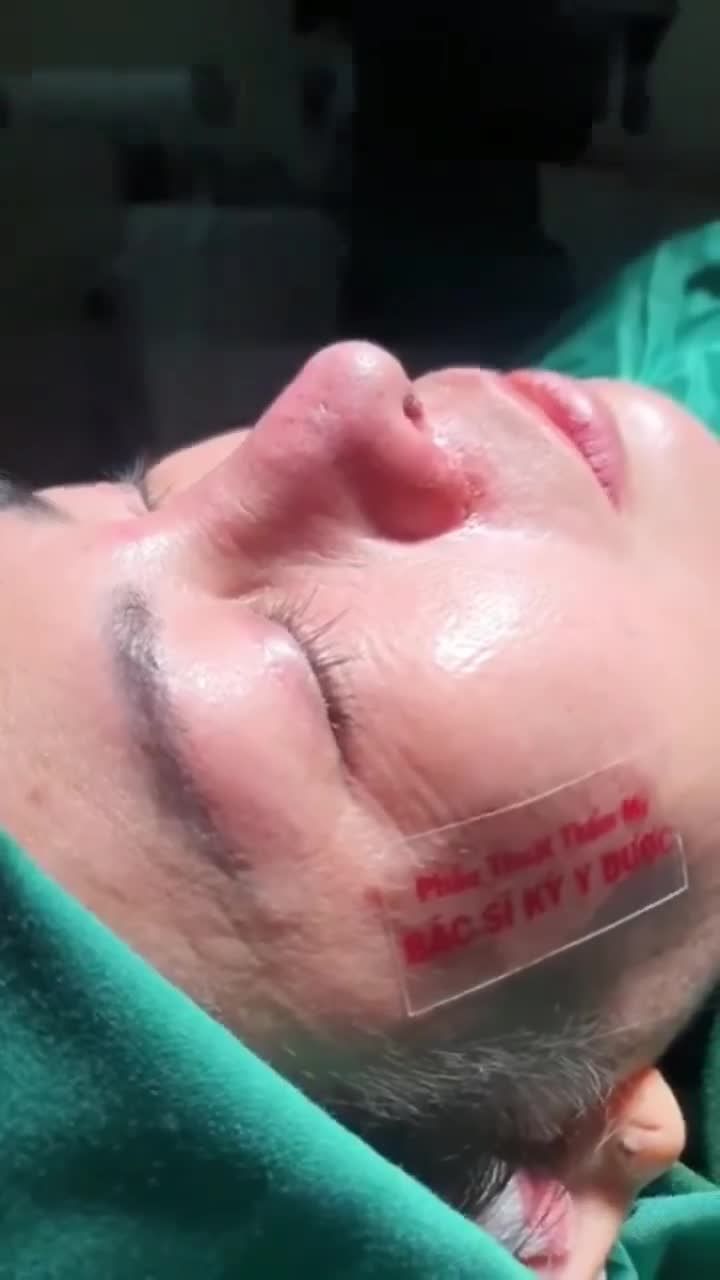 Phương pháp Nâng Mũi ALINE Cấu Trúc 2 Lớp + Thu Cánh Mũi.
