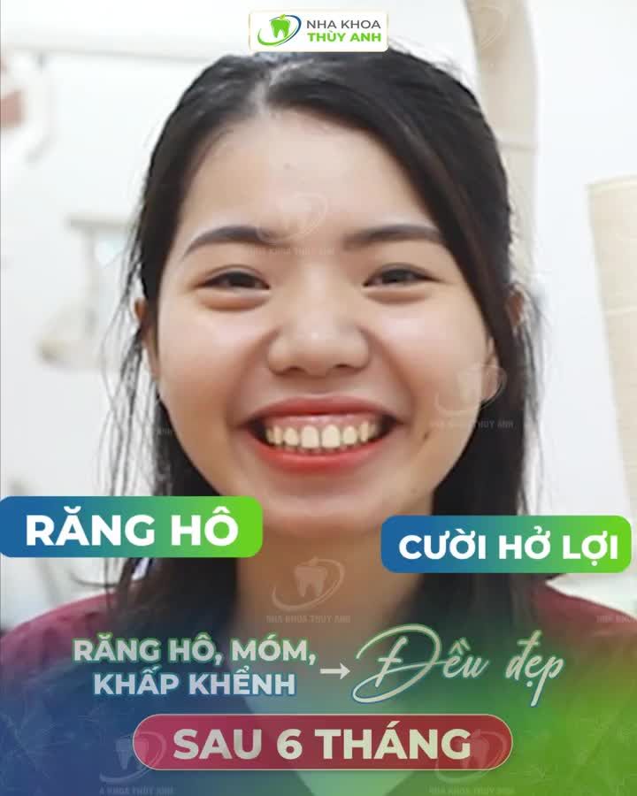 SƠ HỞ LÀ CÓ HÀM RĂNG ĐỀU NỤ CƯỜI ĐẸP SAU NIỀNG RĂNG
