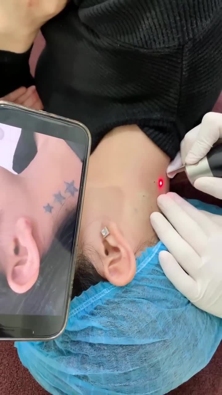 Kết quả xóa xăm sau 2 buổi cho e khách hàng bằng công nghệ Picosure