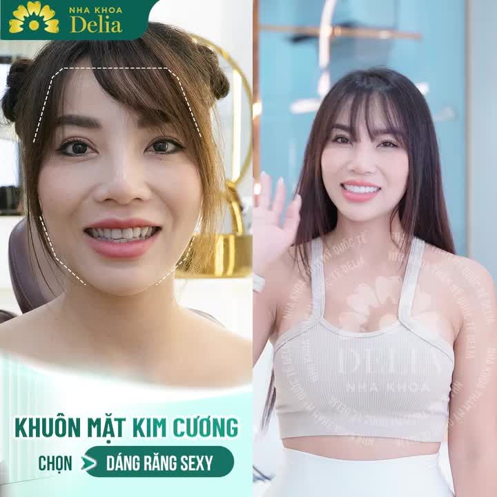 ĐẾN DELIA LÀM RĂNG SỨ - TRỰC TIẾP BÁC SĨ THIẾT KẾ DÁNG RĂNG