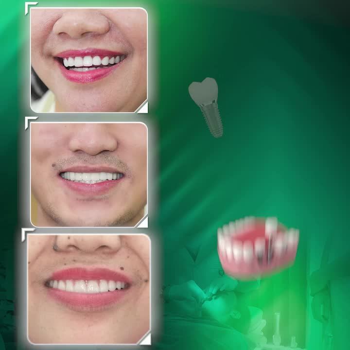 TRỒNG RĂNG IMPLANT - NHANH CHÓNG LẤY LẠI KHẢ NĂNG ĂN NHAI HOÀN HẢO