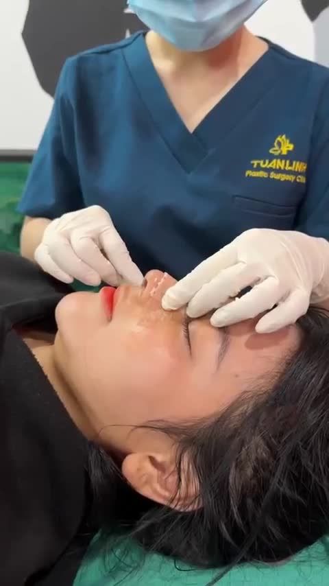 Case mũi cấu trúc sau 5 ngày