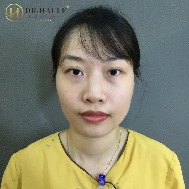 Đến ngay Dr.Hải Lê thẩm mỹ mắt tháng 3 này, bạn sẽ sở hữu ngay cho mình đôi mắt độc quyền chỉ sau 30p