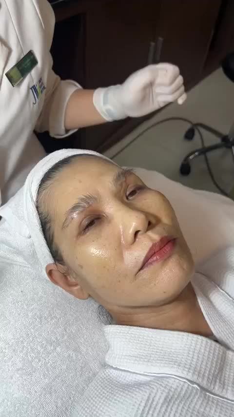 Quý cô U60 có làn da SẠM MÀU và ĐỐM NÂU đến JW trẻ hóa da với LASER MỤN THỊT + TIÊM SÁNG DA sở hữu làn da mịn màng