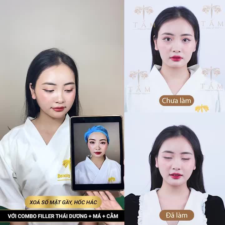 LỰA CHỌN COMBO FILLER TẠI TẤM BẠN ĐƯỢC GÌ?