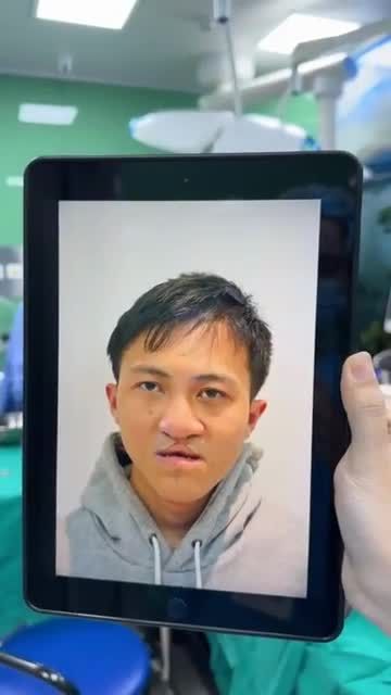 Phẫu thuật di chứng khe hở môi vòm tạo hình vạt niêm mạc miệng cho bệnh nhân 21t