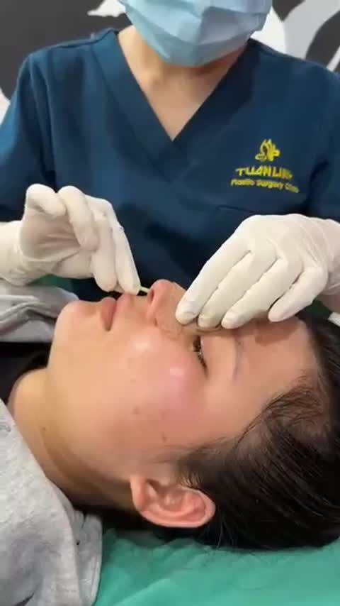 Case mũi cấu trúc sau 10 ngày
