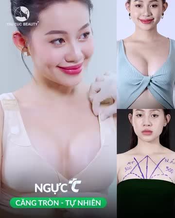 Khách hàng nâng ngực 300cc
